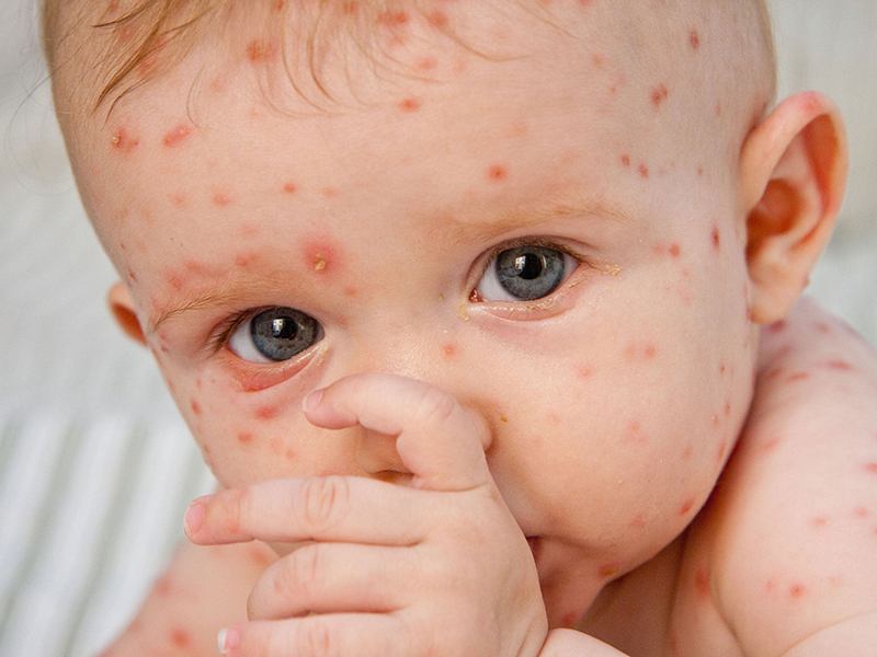 Triệu chứng thủy đậu ở trẻ sơ sinh cơ thể trẻ bắt đầu nổi các vết phát ban đỏ trên da với kích thường từ 1 - 3 mm