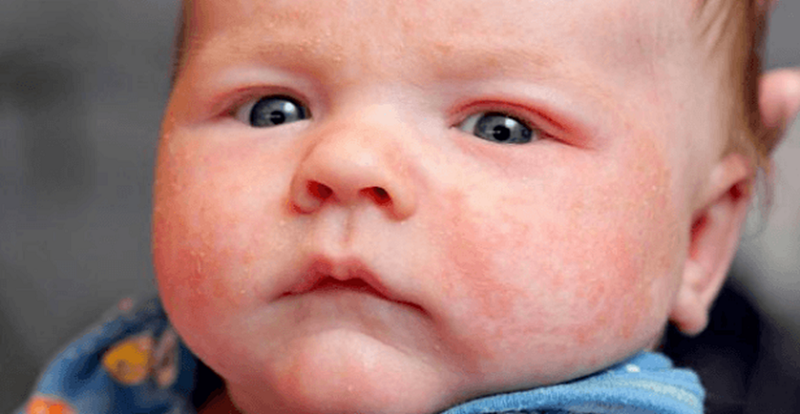 Rối loạn chức năng hệ thống miễn dịch là một trong những lí do vì sao trẻ sơ sinh hay bị bệnh chàm sữa