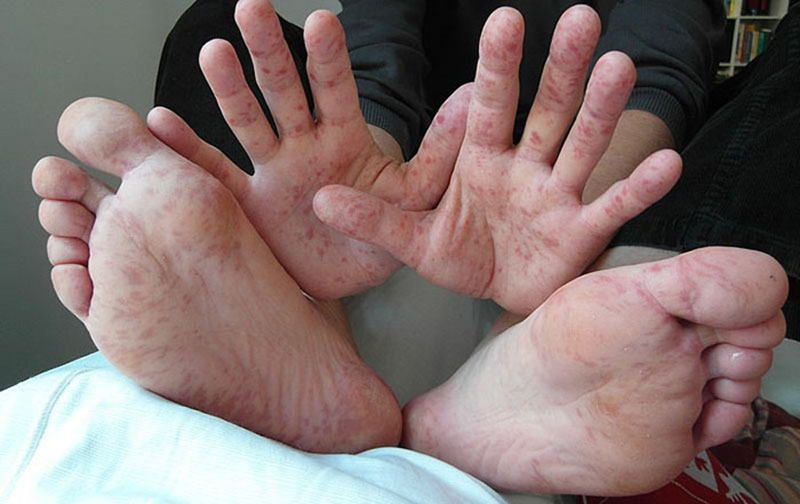 Bệnh chân tay miệng do virus gây ra, trong đó chủ yếu là virus Coxsackie, Echo