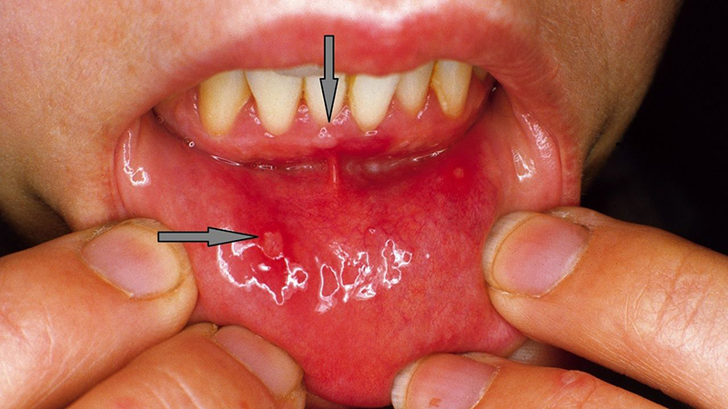 Một trong những đặc điểm bệnh tay chân miệng ở người lớn đó là xuất hiện loét miệng