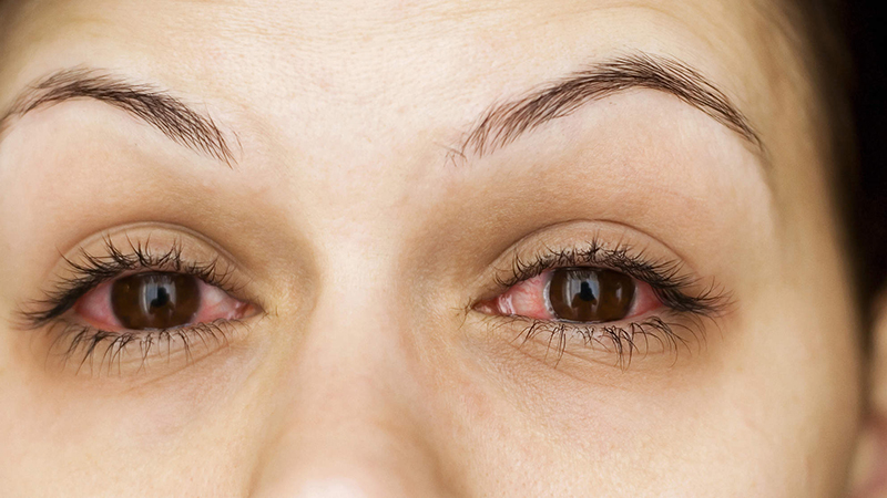 Đau mắt đỏ là nguyên nhân hàng đầu dẫn đến đỏ mắt 