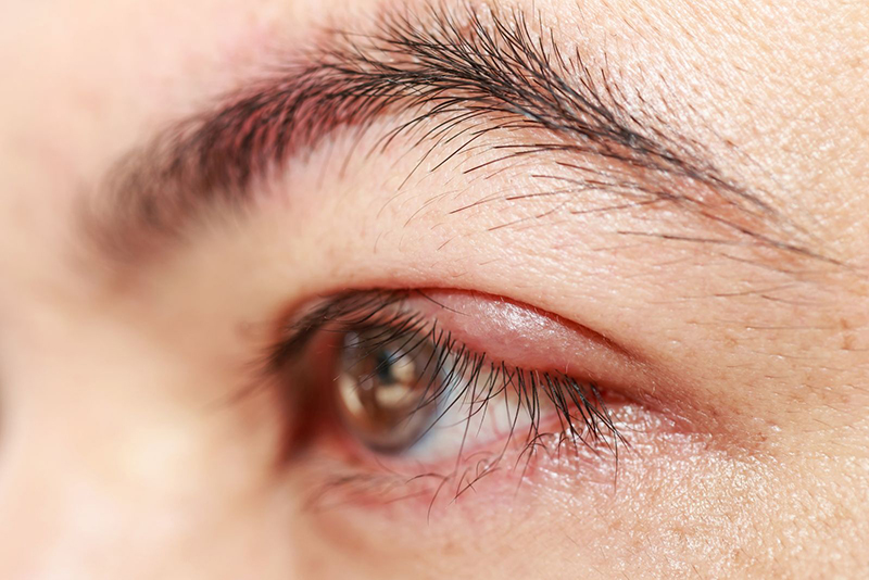 Đỏ mắt là triệu chứng của viêm mi mắt 