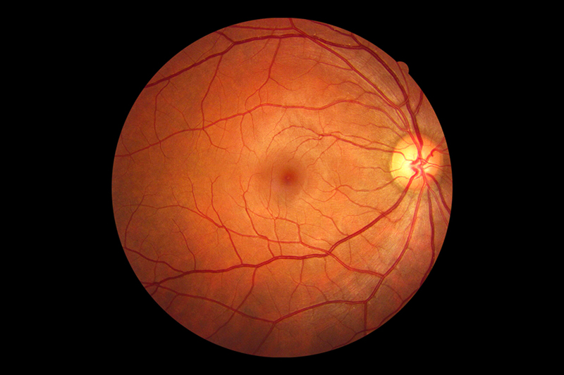 Tắc nghẽn trung tâm võng mạc được xem là nguyên nhân gây tình trạng mờ ở mắt