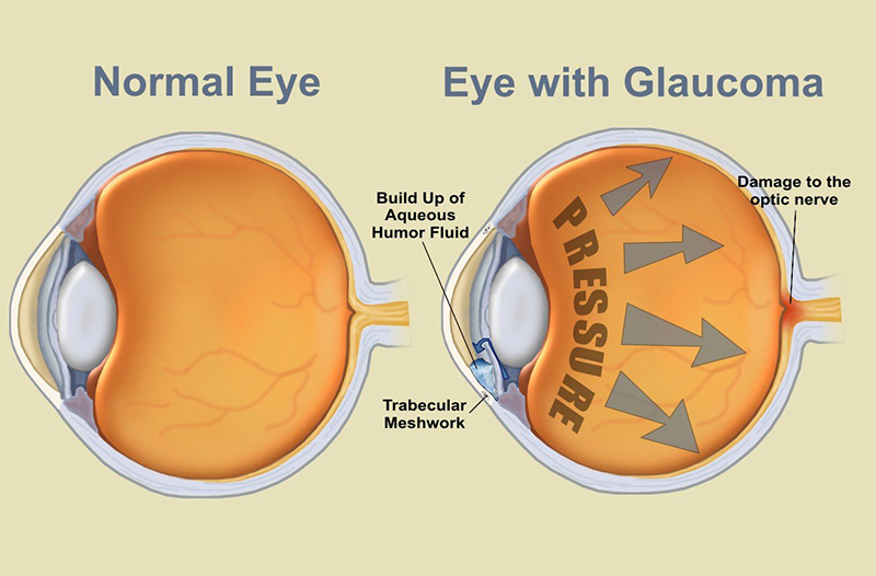 Bệnh tăng nhãn áp làm giảm thị lực của mắt 