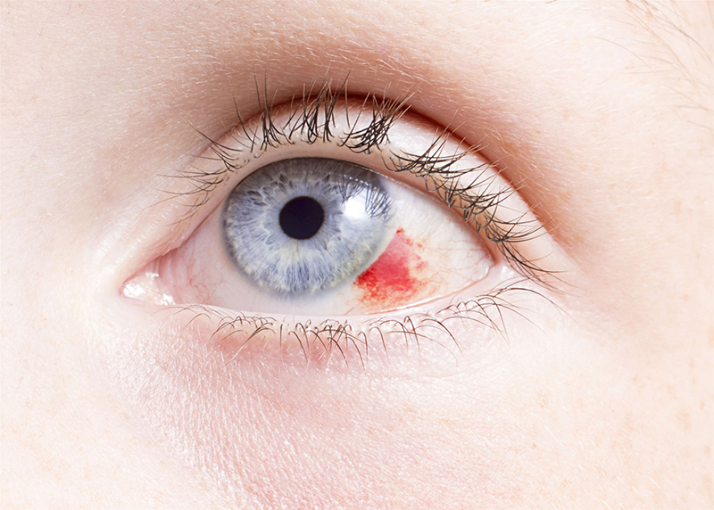 Xuất huyết dưới kết mạc mắt tạo ra hiện tượng đỏ mắ