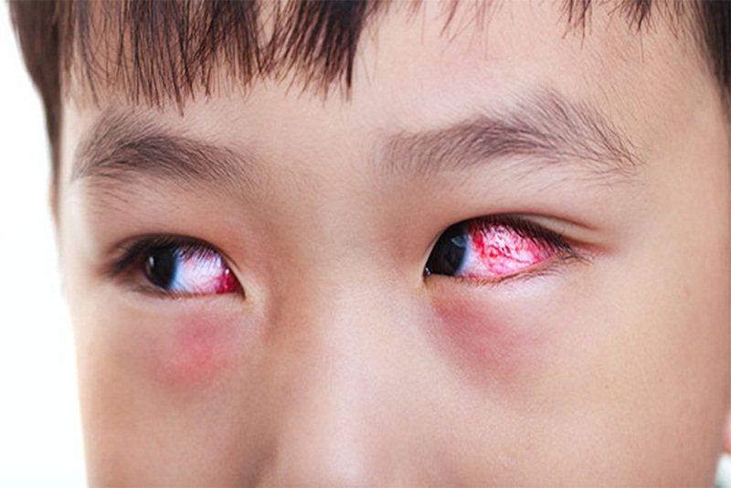 viêm kết mạc herpes còn gọi là đau mắt đỏ