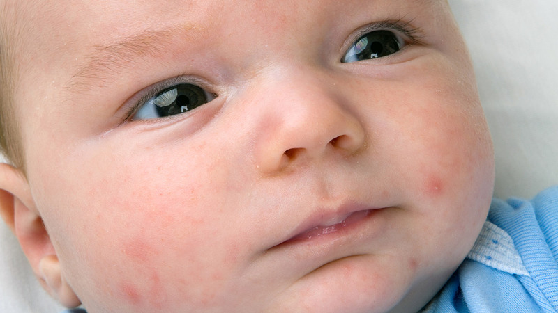 bệnh chàm sữa là bệnh viêm da thường gặp ở trẻ sơ sinh