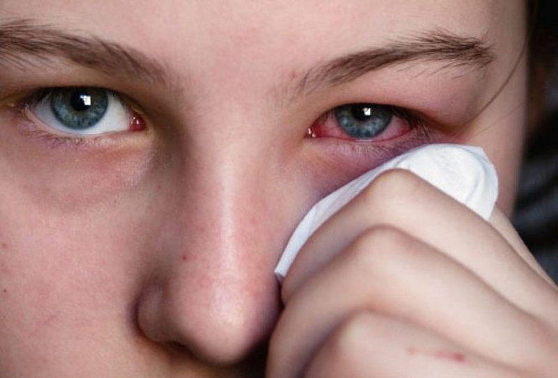 Bệnh khô mắt rất phổ biến hiện nay