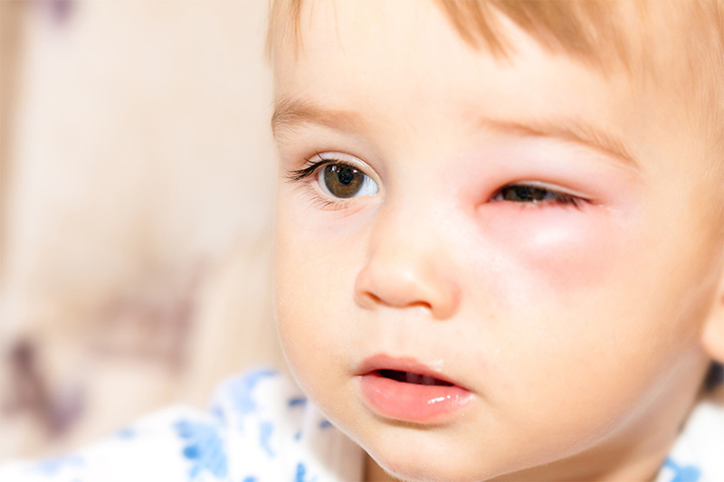 Mắt trẻ có thể bị sưng nặng do vi khuẩn gây viêm kết mạc mắt