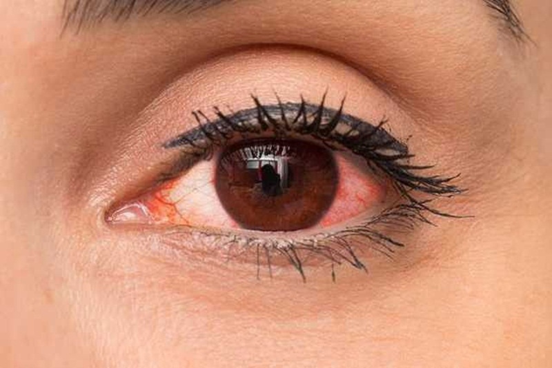 Nhiễm trùng mắt có thể do nhiều nguyên nhân gây ra