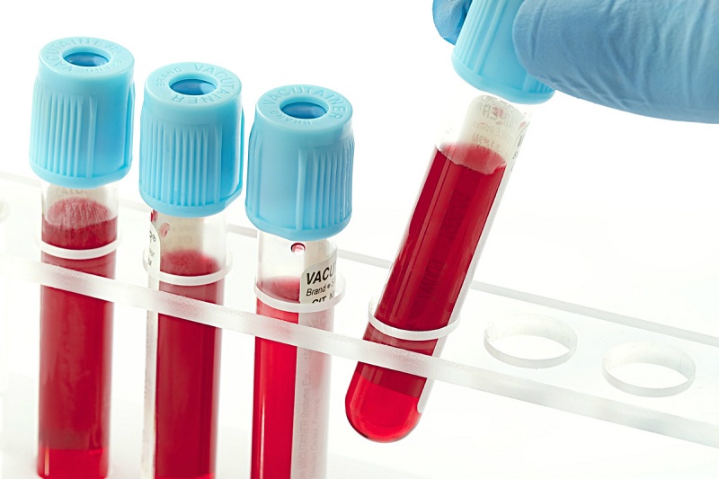 Xét nghiệm máu giúp chẩn đoán chính xác bệnh sởi