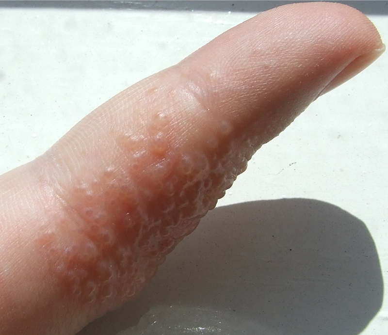 Các nốt mụn li ti xuất hiện trên ngón tay là triệu chứng bệnh tổ đỉa