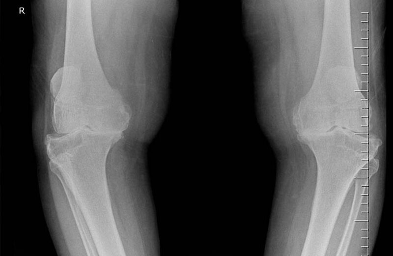 Chụp X-quang cho phép kiểm tra chi tiết hình ảnh khớp tổn thương
