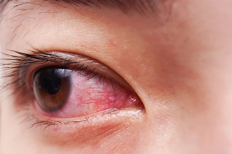 Đỏ mắt do nhiều nguyên nhân, có thể là nhiễm khuẩn, dị ứng hoặc do virus