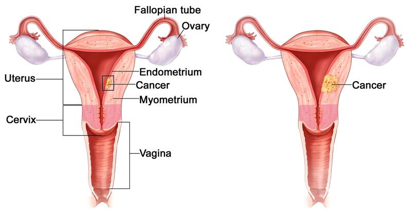 Phụ nữ bị buồng trứng đa nang có nguy cơ ung thư nội mạc tử cung cao hơn