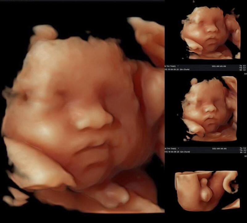 Siêu âm màu cho phép quan sát chi tiết hơn hình ảnh thai