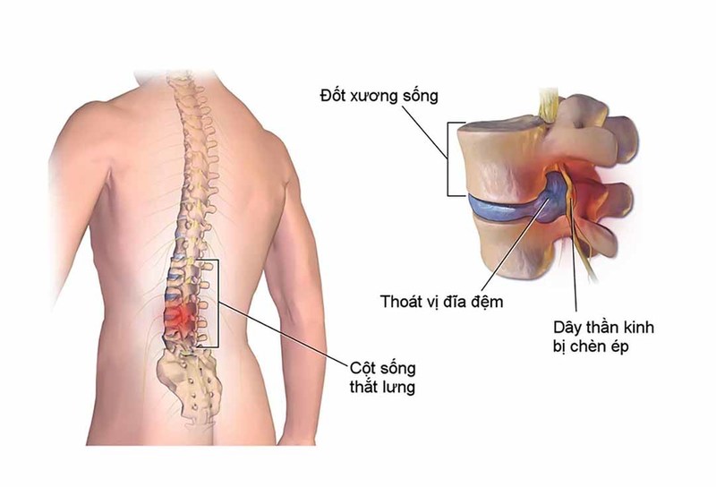 Hội chứng thắt lưng hông do tổn thương cột sống và rễ thần kinh