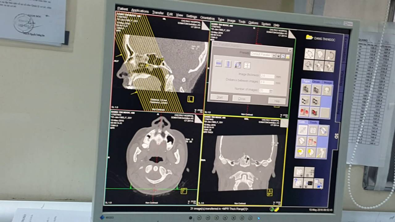 Chụp CT có thể được dùng trong chẩn đoán viêm xoang