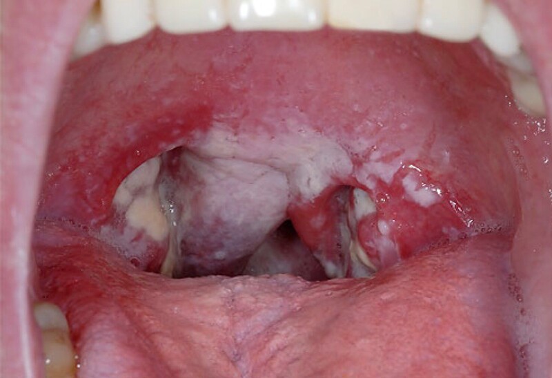 Viêm họng nhiễm khuẩn thường gặp ở trẻ em và người hệ miễn dịch kém