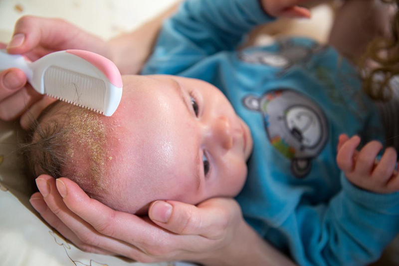 Viêm da tiết bã ở trẻ nhỏ thường có dạng vảy xuất hiện chủ yếu trên đầu