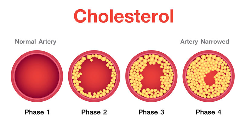 Bệnh nhân đái tháo đường dễ bị tăng cao Cholesterol
