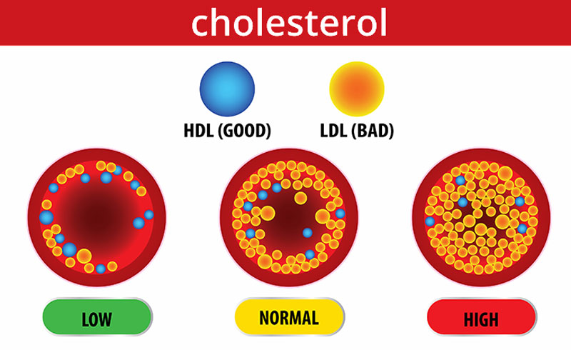 Cholesterol máu cao có thể do yếu tố di truyền