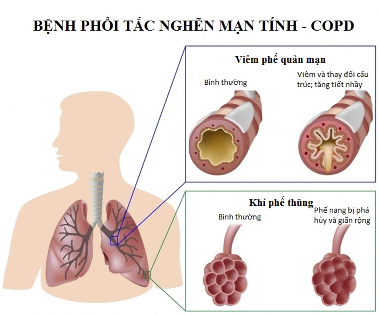 Bệnh phổi tắc nghẽn mạn tính (COPD) là bệnh có những tổn thương ở phổi tồn tại trong thời gian dài.