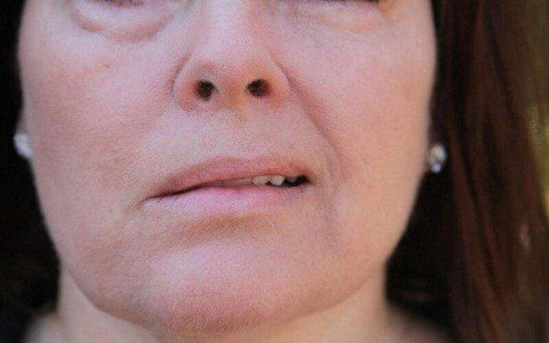 Bệnh nhân đột quỵ thường có dấu hiệu mất cân xứng ở mặt