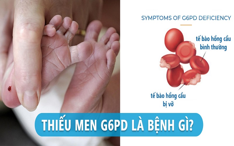 Sàng lọc sơ sinh bằng xét nghiệm máu có thể phát hiện sớm bệnh thiếu men G6PD ở trẻ