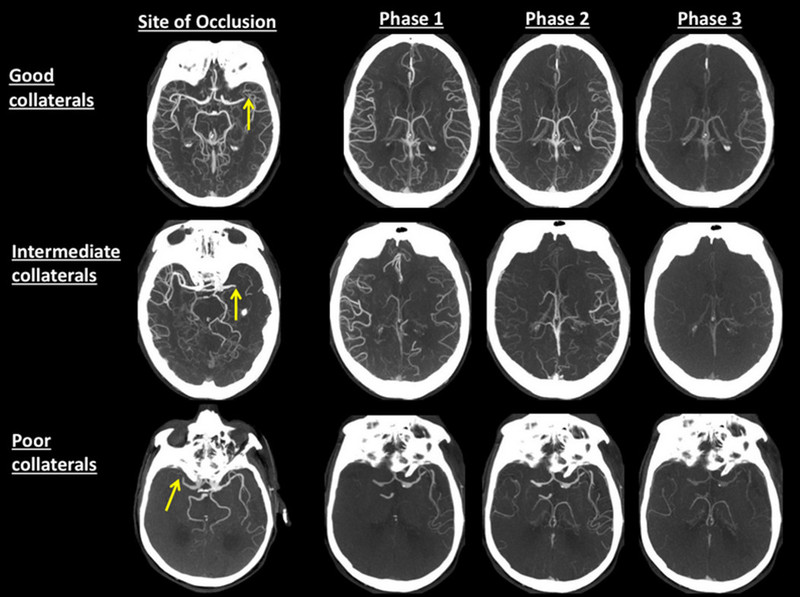 Chụp CT để chẩn đoán nhanh nhồi máu não