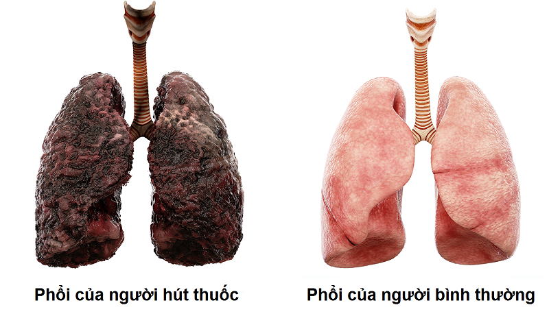 Sự khác nhau của phổi người hút thuốc lá và không hút thuốc