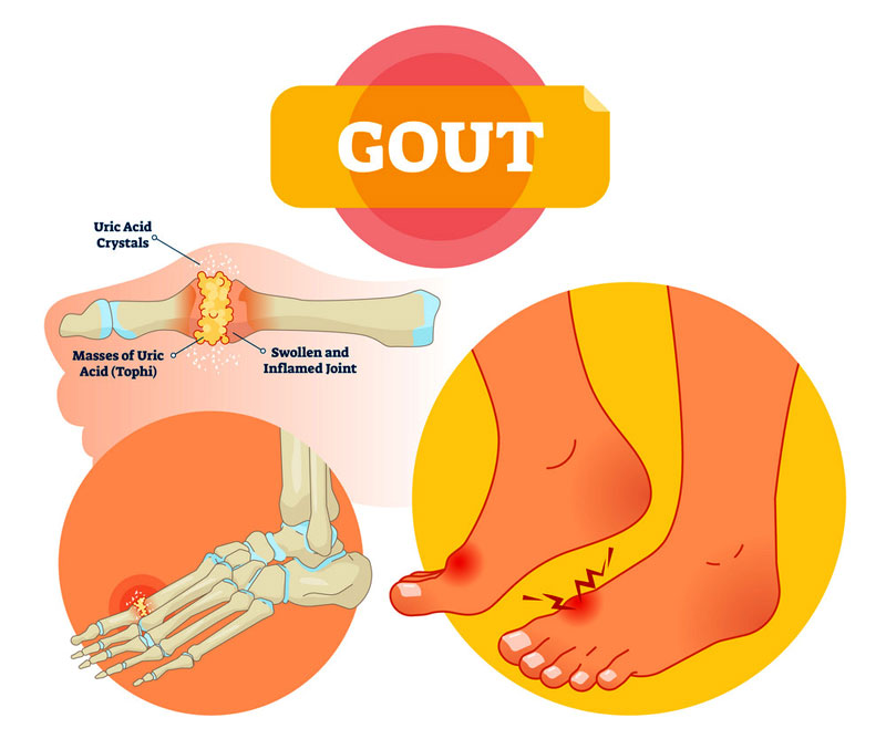 Nồng độ Acid Uric tăng cao gây ra bệnh gout