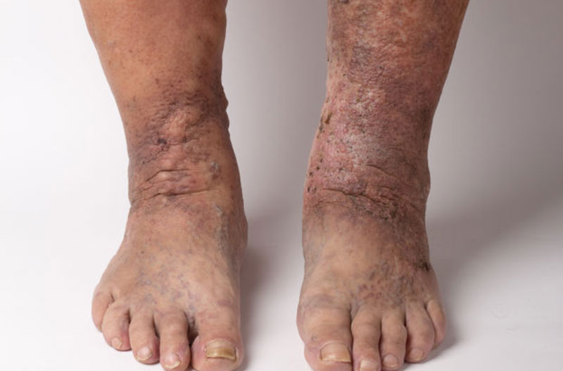 Xuất hiện các vết loét da chân ở giai đoạn sau