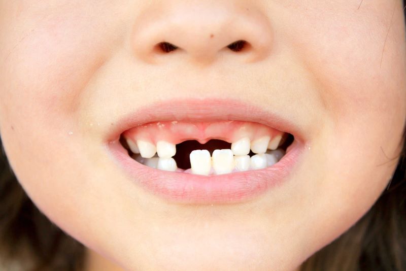 Răng sữa bắt đầu rụng khi trẻ được 6 tuổi