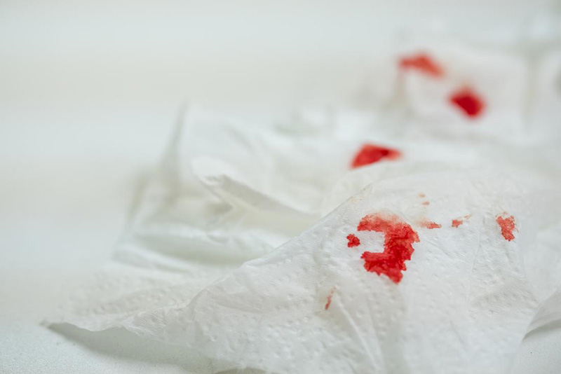 Giấy vệ sinh có máu đọng lại có thể triệu chứng nứt kẽ hậu môn