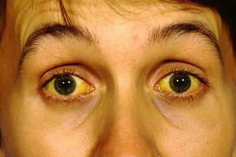 Người bị viêm gan E có triệu chứng điển hình là vàng da, vàng mắt
