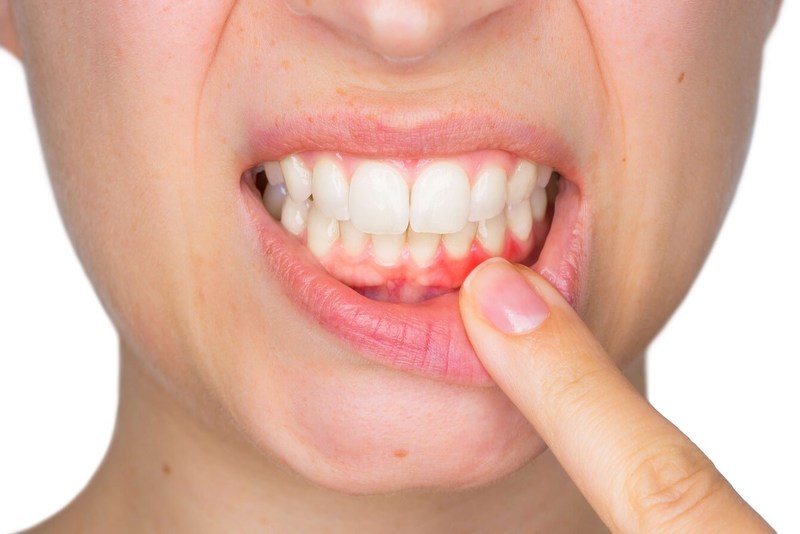 Viêm nha chu không được điều trị có thể gây tổn thương chân răng