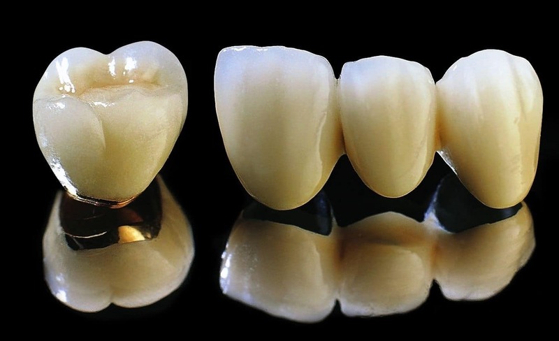 Tuổi thọ của răng sứ kim loại kéo dài khoảng 3 - 5 năm