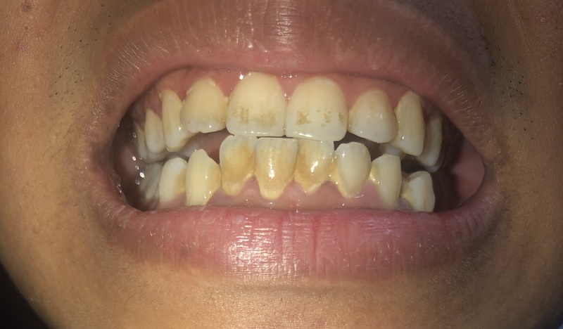 Răng ố vàng chủ yếu do mảng bám trên răng không được loại bỏ tốt