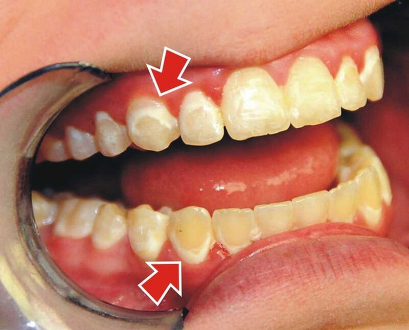 Nhiều người có men răng mỏng và màu răng ngả vàng hơn so với bình thường