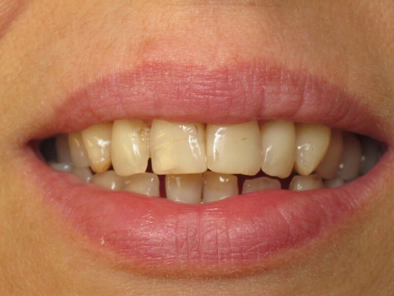 Các phương pháp tẩy trắng răng bên ngoài chỉ tác động đến men răng và mảng bám ngoài răng