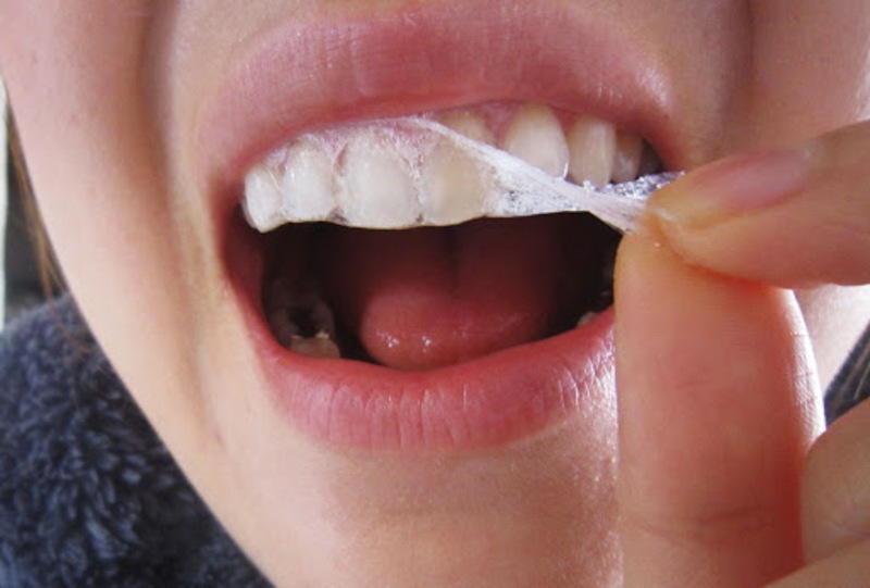 Miếng dán trắng răng có tác dụng nhanh