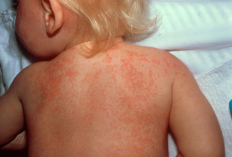 Các nốt ban khi bị sốt phát ban thường có màu đỏ và sáng, nổi mụn trên mặt da