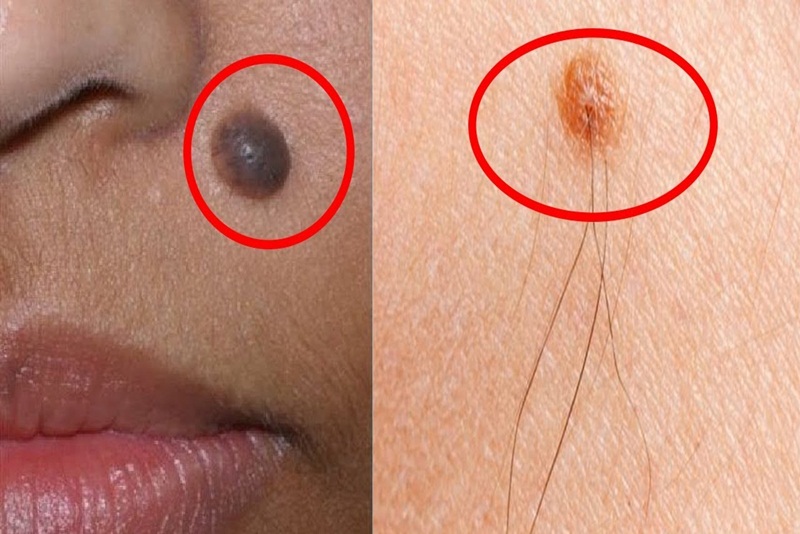 Nốt ruồi có thể rất to hoặc có hiện tượng mọc lông trên nốt ruồi