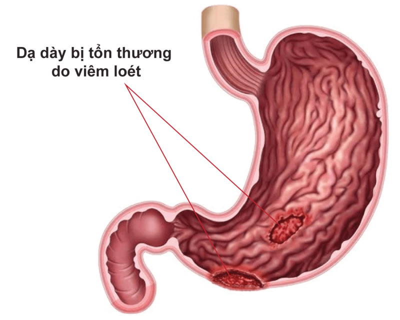 Viêm loét dạ dày tá tràng là nguyên nhân thường gặp gây đau dạ dày
