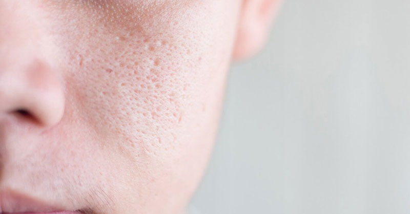 Bạn đã biết tất tần tật về nguyên nhân dẫn tới lỗ chân lông mặt to