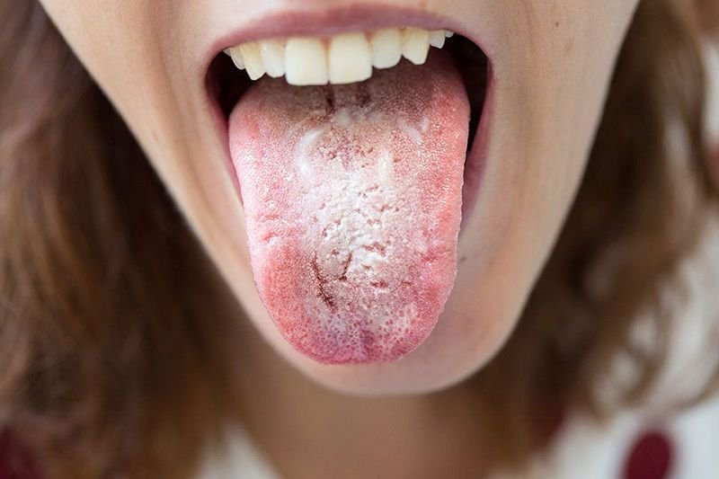 Nấm miệng là bệnh lý khoang miệng do trào ngược dạ dày thường gặp ở nhiều người