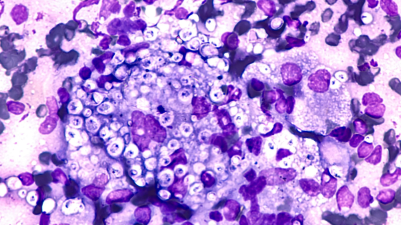Nhiễm nấm Histoplasma có thể tồn tại trong cơ thể người rất lâu trước khi phát bệnh