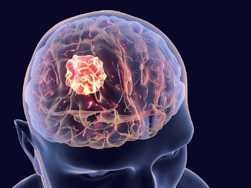Ung thư di căn não có thể điều trị bằng xạ trị