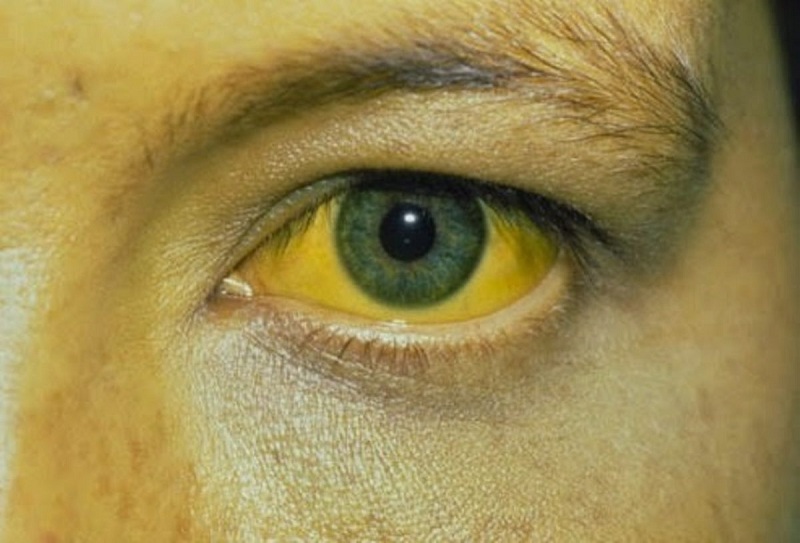 Vàng mắt, vàng da là một trong số các biểu hiện thường thấy ở người bị gan to
